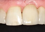 After - The Queens Dental Practice