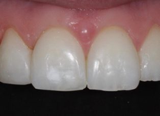 After - The Queens Dental Practice
