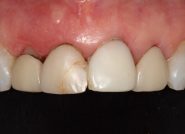 Before - The Queens Dental Practice